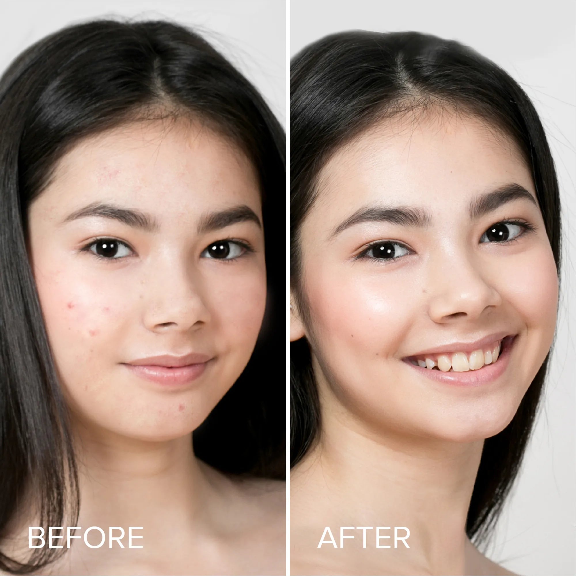 Marine Collagen Acne Patches – Dermatologist-Recommended Blemish Treatment (72 Dots)
